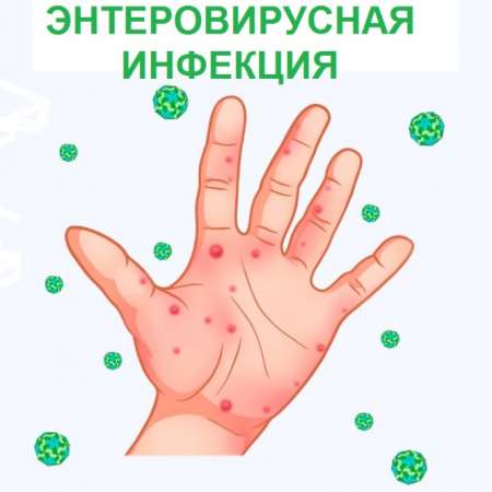 Профилактика энтеровирусной инфекции